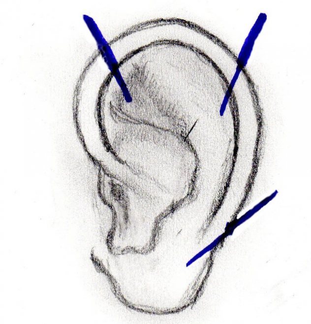 AURICULOTERAPIA