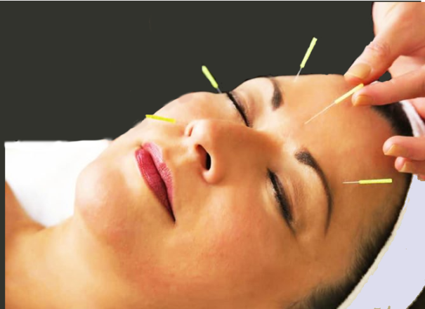 LIFTING ACUPUNTURA ESTÉTICO FACIAL